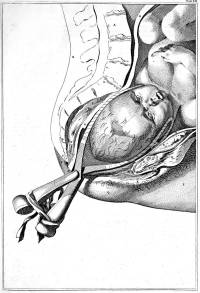 Dessin de William Smellie d'un accouchement avec des forceps (1751).